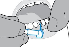 Seque minuciosamente la plantilla y rellene con una pequeña cantidad de composite cada cavidad de attachment de la plantilla hasta que ésta rebose ligeramente. 6 Conformado en los dientes.
