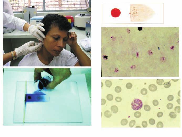 Figura 8 Método de Gota gruesa y extendido Fuente: Centro para Estudios sobre la Malaria - SA IAE Dr. Arnoldo Gabaldón. Tabla 2 Gota gruesa y extendido de sangre teñidos con Giemsa.