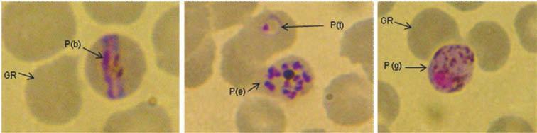 Figura 11 Plasmodium malariae Extendidos GR: Glóbulo rojo