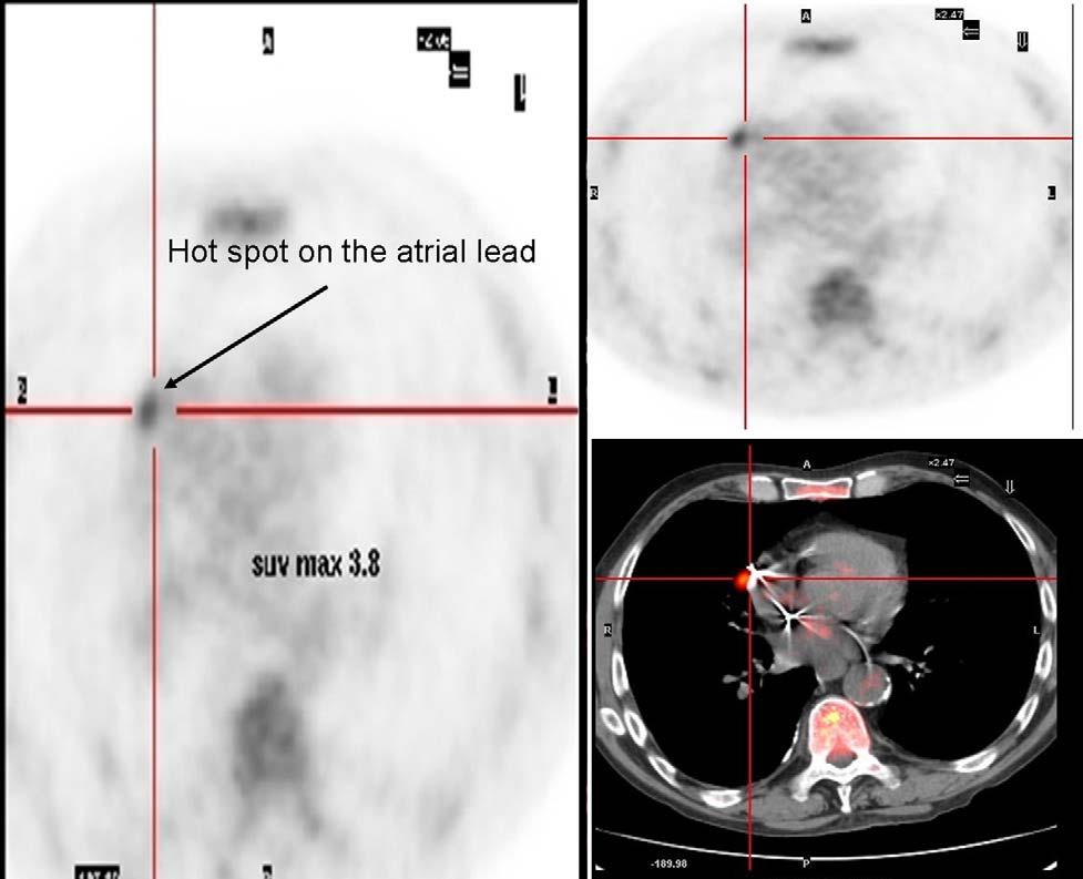 Otras exploraciones Diagnóstico embolias pulmonares sépticas AngioTC pulmonar gammagrafía
