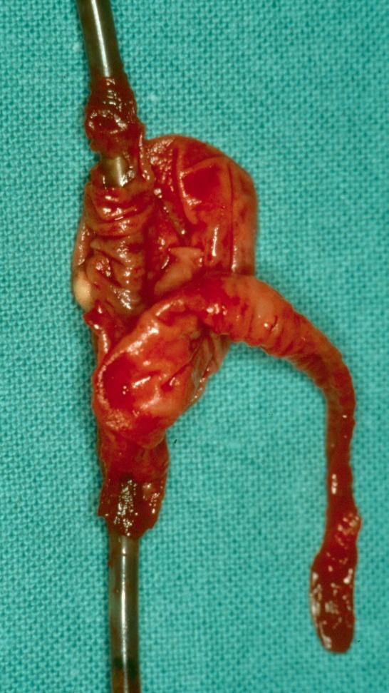 Retirada Cirugía < Riesgo desgarro estructuras cardiacas Evita diseminación vegetaciones Permite realización de otros procedimientos Alarga estancia hospitalaria Mortalidad 0-16,7% Complicaciones: