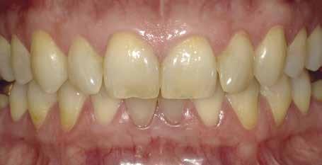 Cuatro flashes: dos iluminaciones diferentes La combinación de los flashes laterales permite iluminar a la perfección la zona de la boca, así como minimizar los reflejos en los dientes.