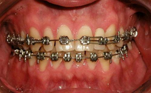 P á g i n a 9 En la fotografía intraoral de frente se observa línea media dental inferior desviada 1,5 mm a