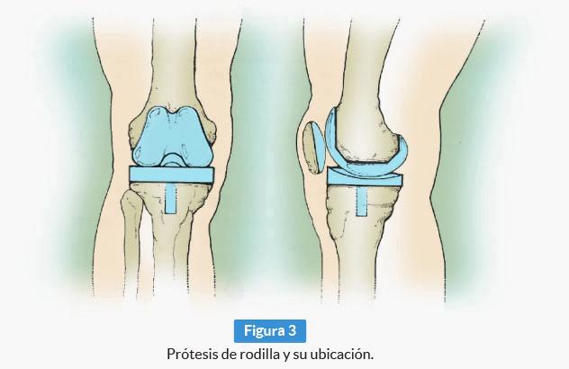 La cirugía de reemplazo de rodilla será necesaria sólo si el dolor y la pérdida de fuerza muscular o movilidad lo afectan en su actividad diaria y el tratamiento antes descripto no ha sido efectivo.