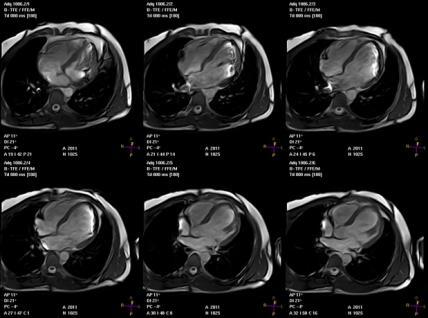Imagen en Cardio-Oncología: FEVI FEVI 2D biplano Rutina Limitaciones Revisar estudios Métodos semiautomáticos Contraste FEVI 3D Mejor