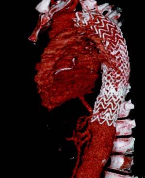 previo, por lo que se colocó una endoprótesis torácica de 28 mm de diámetro (thoracic endovascular aneurysm repair, TEVAR), cubriendo el trayecto de la aorta torácica descendente y excluyendo el