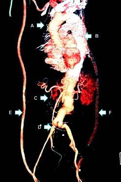 La paciente presentó adecuada evolución post-tevar; sin embargo, a los 33 años de edad, en seguimientos tomográficos de rutina, se apreció una dilatación aneurismática de la aorta infrarrenal de 53