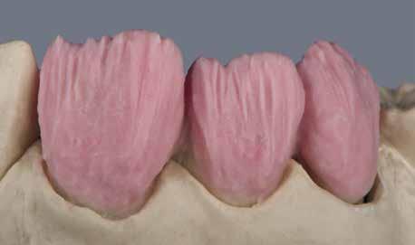 Si solo hay poco espacio (menos de 0,6 mm), o al laminar los pónticos, el efecto tono puede ser mejorado usando Opaque Dentin.