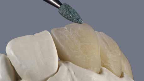 Las formas del diente y los detalles de la superficie cóncava /convexa del diente son contorneadas adecuadamente con los