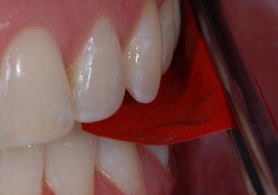 Se realiza tras la limpieza dental en el diente antes de la preparación o en los dientes