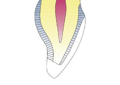 Reducción incisal con inclinación hacia palatino (dirección de inserción incisal) Borde de preparación reducido en incisal pero ubicado en labial