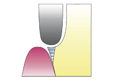 Preparación y grosores de la capa de cerámica Coronas La preparación de coronas de cerámica sin metal puede realizarse en forma de chanfer o en forma de hombro con ángulo interior redondeado