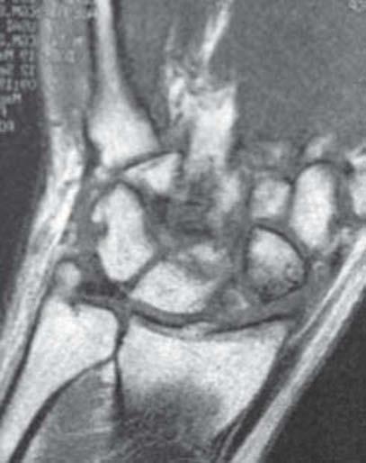Figura 6 Pseudoartrosis de escafoides en la muñeca izquierda con afectación mediocarpiana (SNAC III) en un paciente varón de 35 años. A) Tomografía computarizada. B) Resonancia magnética. volares.