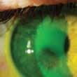 DIÁMETRO El diámetro horizontal del iris visible (DHIV) es el factor principal a considerar para determinar el diámetro del lente.