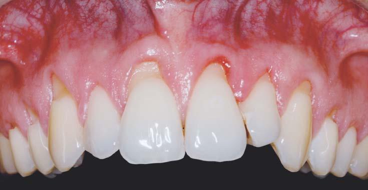 desgaste del esmalte coronal, con la consiguiente exposición de la dentina coronal que, en teoría, no podrá cubrirse 5.