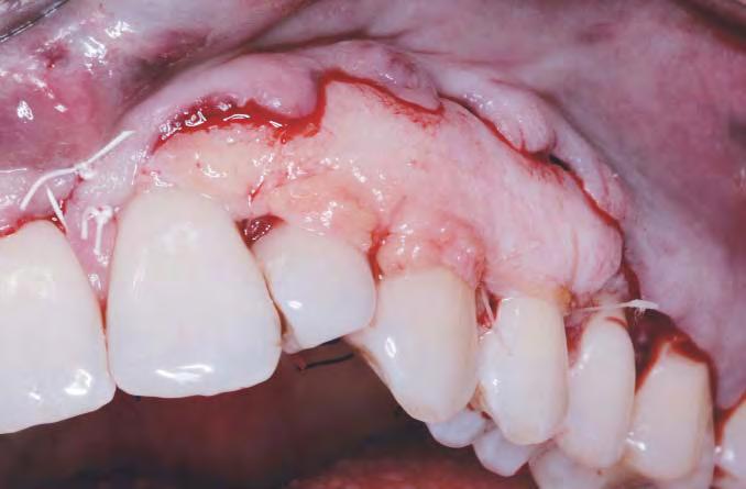 Colocación del injerto sobre los dientes