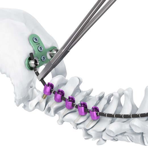 Fijación occipito-cervical con placa occipital 9. Moldeado de la barra de prueba Instrumento 388.868 Barra de prueba de B 3.5 mm Instrumento opcional 03.614.
