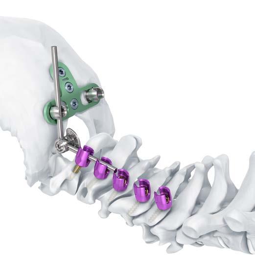 Realice el doblado occipito-cervical y asegúrese de que haya suficiente longitud de barra para conectar con la placa occipital.