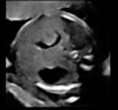 cortes vamos a valorar el situs fetal, así como defectos de la pared abdominal anterior, los cuales se deben diagnosticar en el primer trimestre, como se mencionó en el capítulo de TN.