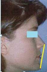 2.3 Perfil facial en un paciente clase ll esqueletal 2.3.1 Línea estética de Ricketts Línea que pasa por el punto (Pg) Pogonion, uniéndolo con el punto más anterior de la punta de la nariz.