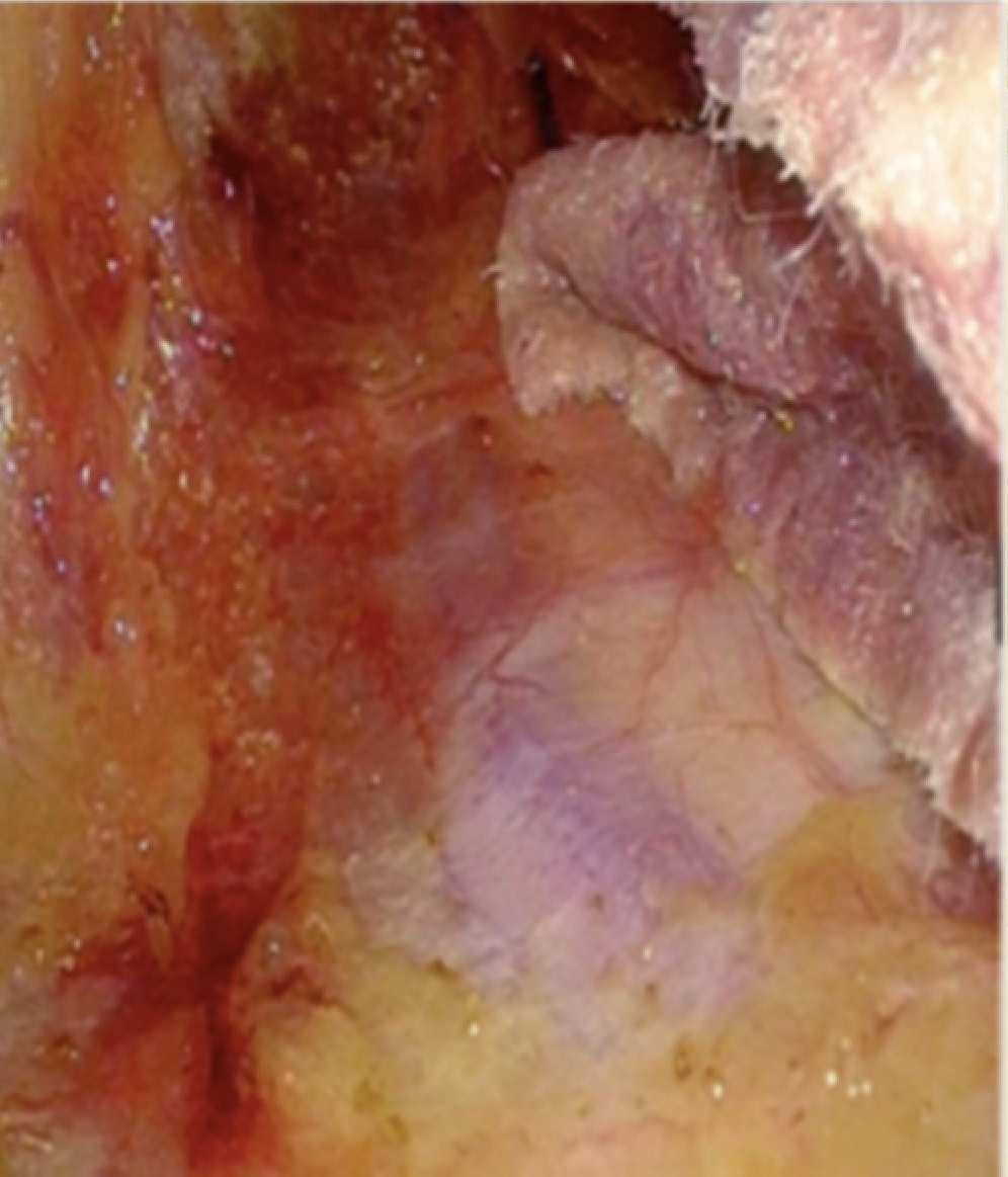 esfínter interno (tipo III) o la disección de toda la mucosa desde la línea dentada (tipo II).
