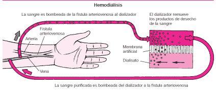 Hemodiálisis Un aparato de hemodiálisis tiene un filtro especial llamado un dializador o riñón artificial,