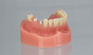 Utilizando casquillos de titanio Sobre la base de la impresión dental, prepare el modelo maestro utilizando los análogos adecuados.