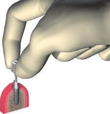 7.5 Apretado de un pilar a 35 Ncm Paso 1 Inserción y atornillado Inserte el pilar en el implante. Apriete a mano el tornillo del pilar con el Destornillador SCS.