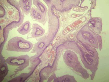 PAPILOMA Órgano: Úvula Técnica: H/E Microscopía: El corte histológico muestra con visión panorámica, un crecimiento
