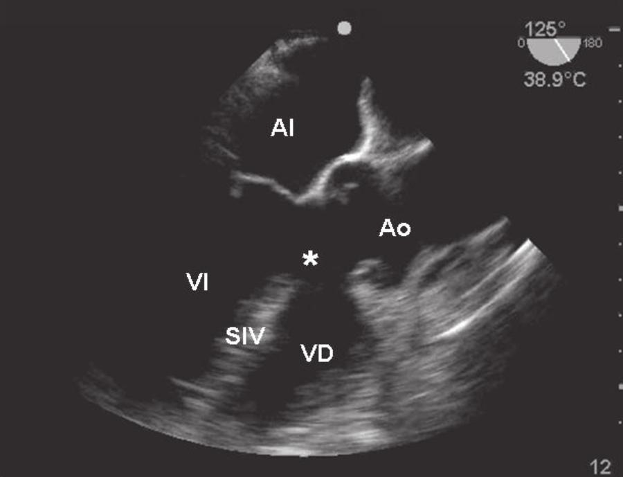 79 Anatomía Fig. 1. Esquema que muestra la falta de alineación del septum conal y flujo preferencial desde el ventrículo derecho hacia la aorta. Fig. 2.