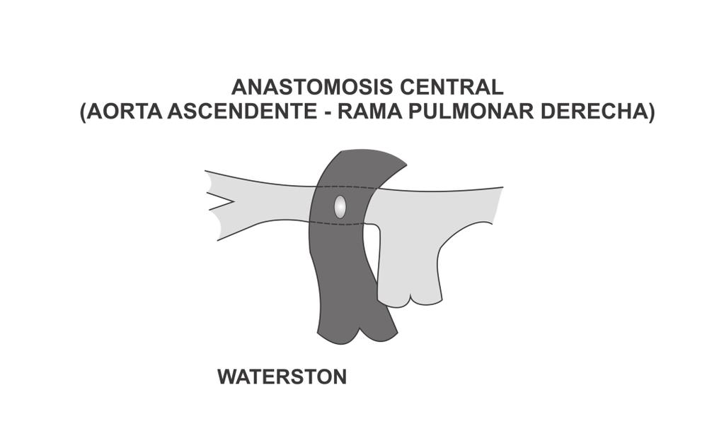 82 Evaluación de las lesiones residuales y conducta terapéutica Fig. 5. Anastomosis central aortopulmonar. Fig. 6.