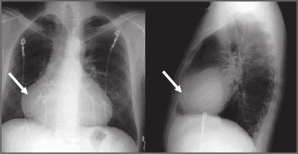 84 El examen clínico revela un soplo diastólico tardío pulmonar de baja intensidad, que puede estar asociado con un segundo ruido desdoblado y un tercer y/o cuarto ruido.
