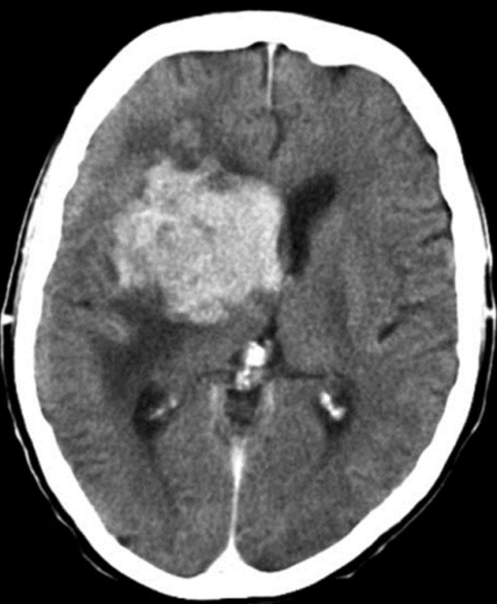 Fig. 4: TC craneal axial con CIV en una paciente inmuunodeprimida con pérdida de conciencia y cefalea.