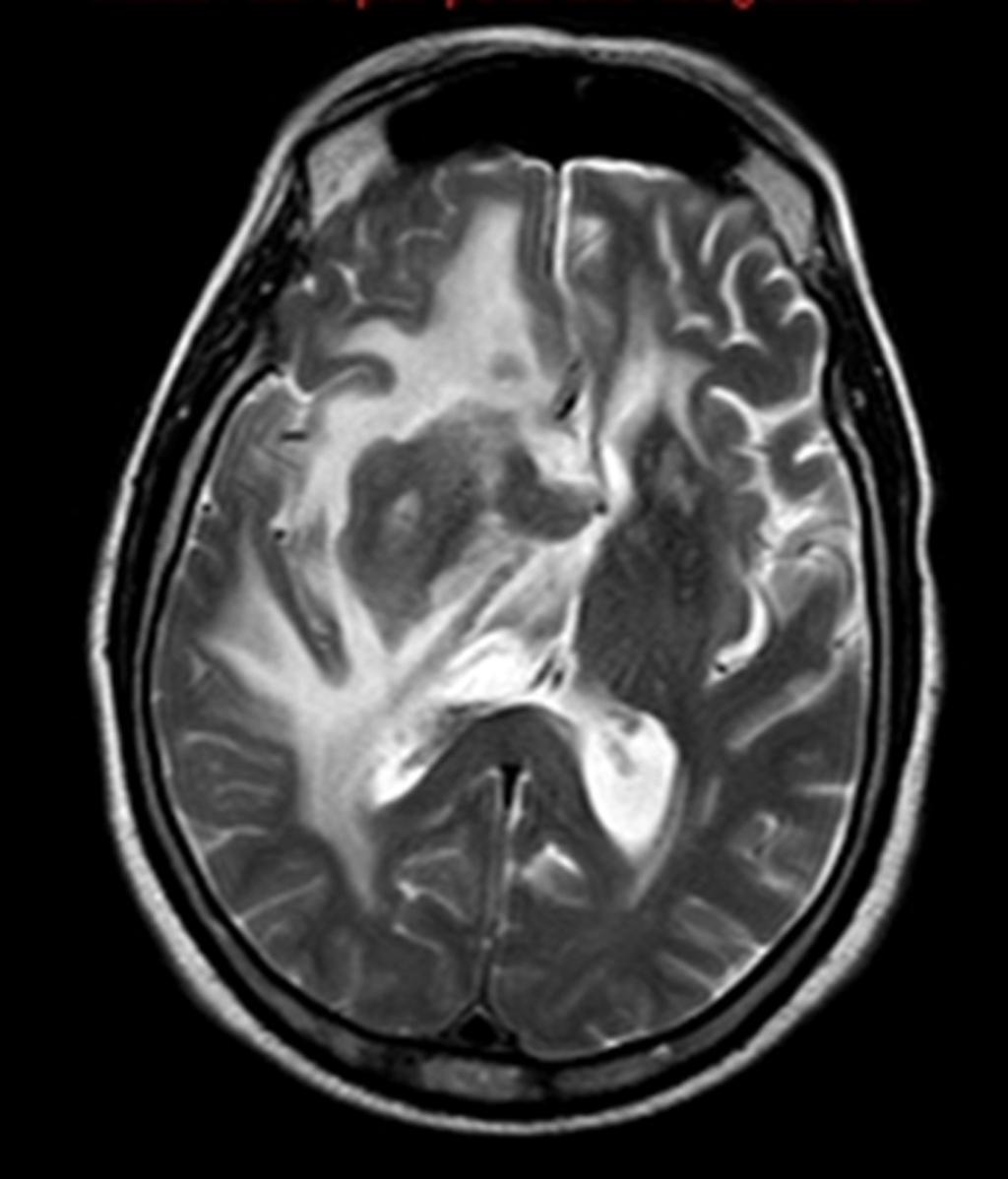 Fig. 8: RM cerebral axial potenciada en T2 donde se observa una masa de bordes imprecisos en hemisferio derecho, con invasión del hemisferio