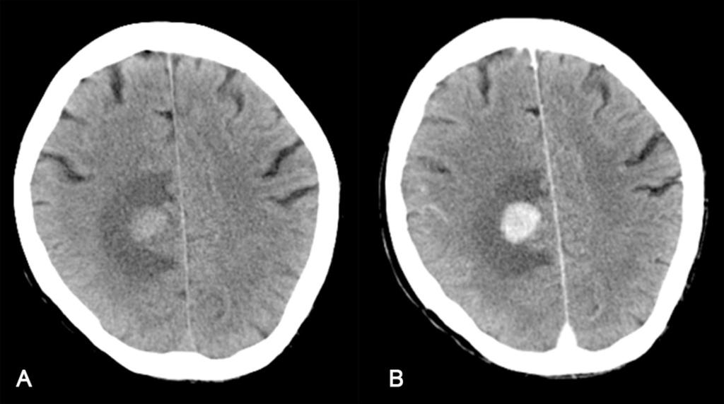 Fig. 2: TC craneal sin y con CIV en un paciente inmunocompetente con un linfoma cerebral primario.
