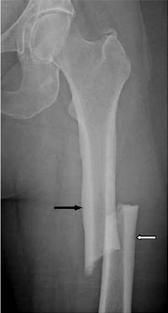 Fracturas atípicas de fémur IBP Subtrochanteric fractures after