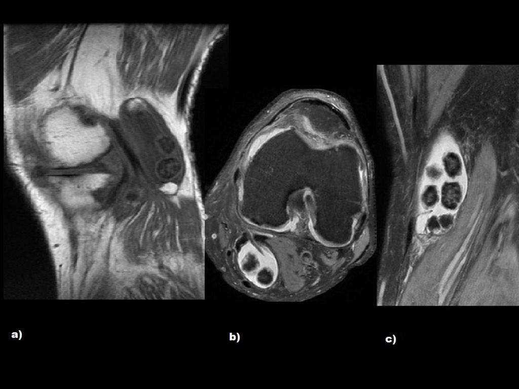 Fig. 5: Radiografía lateral que muestra múltiples cuerpos calcificados de varios tamaños situados en la región poplítea. Fig.