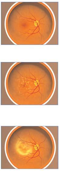 La DMRE se clasifica a menudo en 3 etapas: Etapas de la DMRE 1) Temprana: El paciente no tiene síntomas o pérdida de la visión pero puede tener drusas presentes.