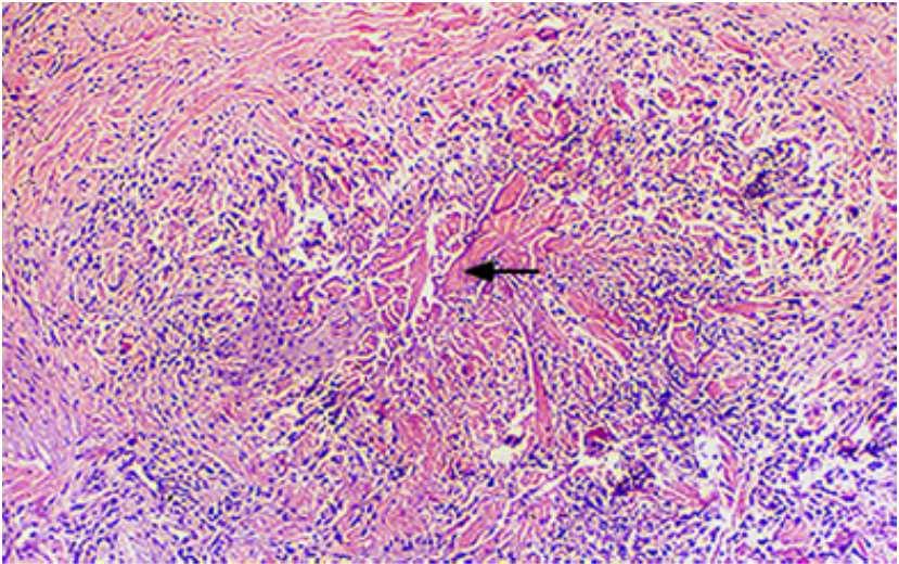Biopsia Renal Lesión granulomatosa túbulo-intersticial con células epitelioides, linfocitos y abundantes eosinófilos. Tubulitis eosinofílica y ruptura de la membrana basal.