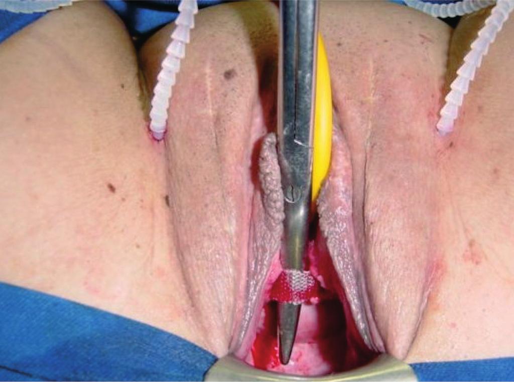 cirujano, que además rechaza y protege las estructuras urinarias. Finalmente, el extremo de la aguja, guiada con el dedo, se extrae a través de la incisión vaginal.