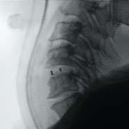 El diseño del implante CeSpace ofrece una zona de contacto máxima entre el implante y los platillos vertebrales.