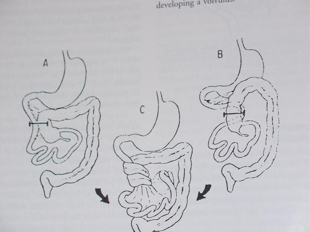 2. Obstrucción del intestino delgado. Atresia. Es la causa más frecuente. Fibrosis quística.