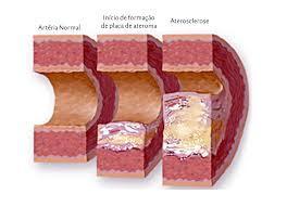 El colesterol que se encuentra en las placas de ateroma proviene tanto de las LDL y la Lp(a) como de las