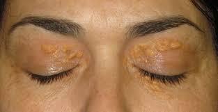 Xantelasmas Area corneal senil antes de los 40 años Coronariopatìa prematura
