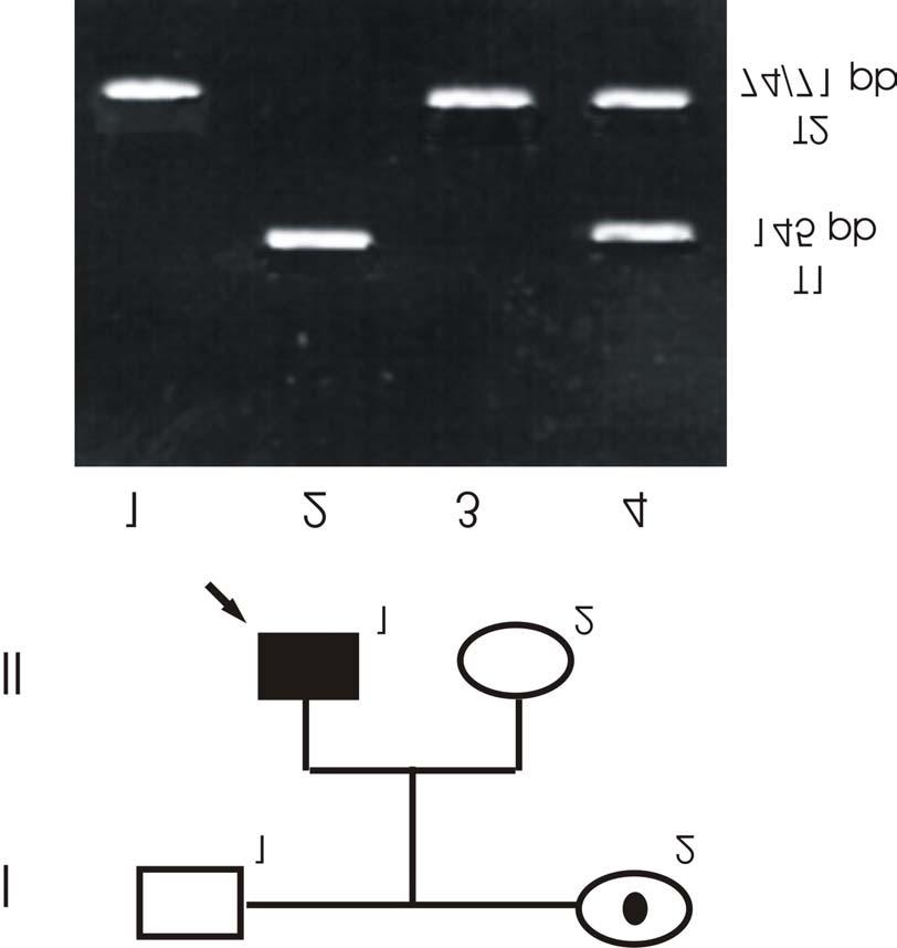 Fig.20. Exclusión del alelo mutado en la hermana del caso índice en una familia con antecedentes de la enfermedad y mutación no caracterizada utilizando pert87.8/taqi.
