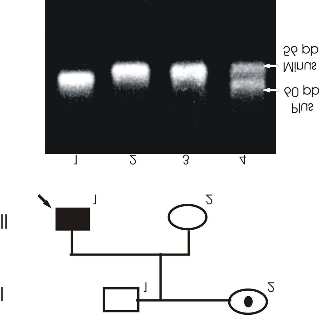 Fig. 22. Exclusión del alelo de riesgo en familia con antecedentes de la enfermedad utilizando el polimorfismo MP1P.