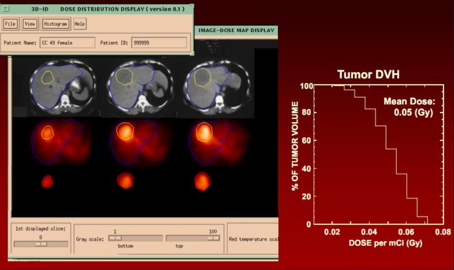 DOSIS-REPUESTA ESTUDIOS DOSIMETRICOS TRIDIMENSIONALES Patient-Specific, 3-Dimensional Dosimetry in NHL Patients Treated with BEXXAR: Tumor Dose Response.