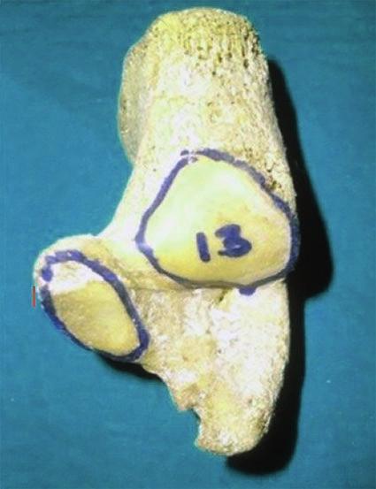 Ukoha Ukoha Ukoha, Obazie Izuchukwu Feechukwu, Chioma Onuoha Study of the morphologic and morphometric patterns of talar articular facets on dry adult calcaneal bones in South-Eastern Nigerian
