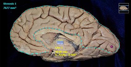 Cara lateral: lóbulos frontal, parietal, occipital, temporal y finalmente, el lóbulo de la ínsula. 2. Cara basal: de rostral a caudal, lóbulos frontal, temporal y occipital 3.