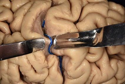 6: Se procede a realizar un corte con un bisturí a nivel de los bordes del hemisferio cerebral que separan la cara lateral del resto de sus caras Fig.